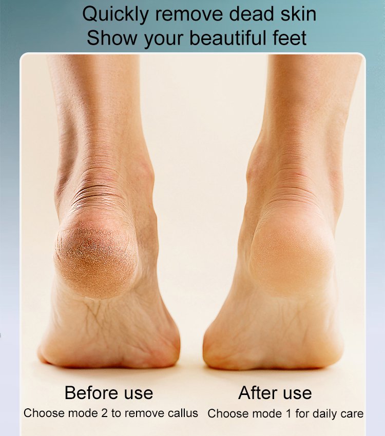 🎁Hot Sale 50 % RABATT🔥Wiederaufladbarer elektrischer Hornhautentferner für den Fuß
